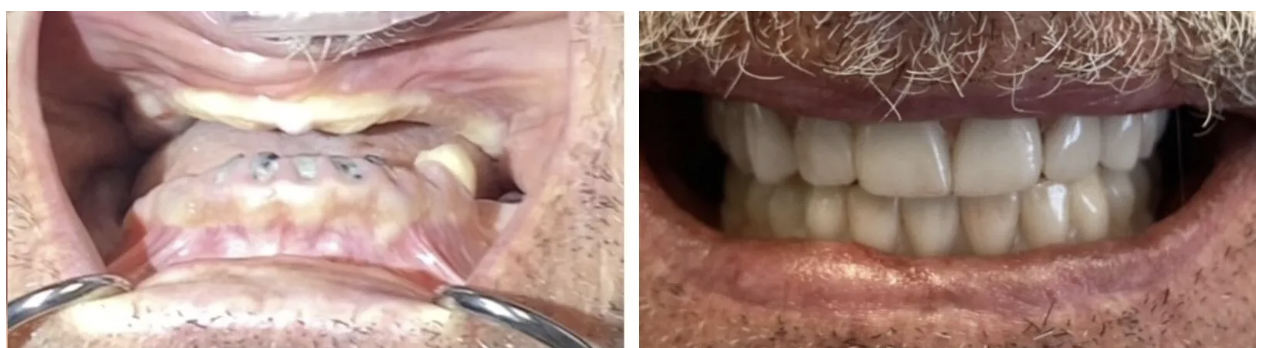Before and after — Full-arch rehabilitation. Case treated by Dr. Tim Silegy, DDS.